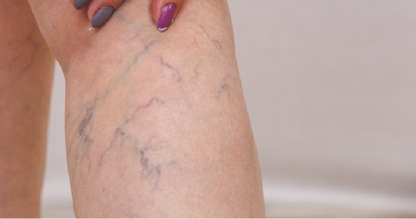 varicose veins treatment in bangalore